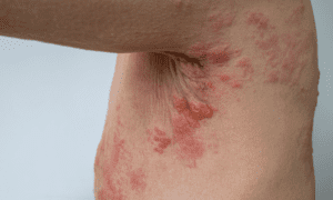 Herpes zoster é contagioso?