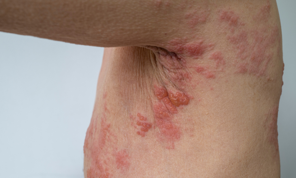 Herpes zoster é contagioso?