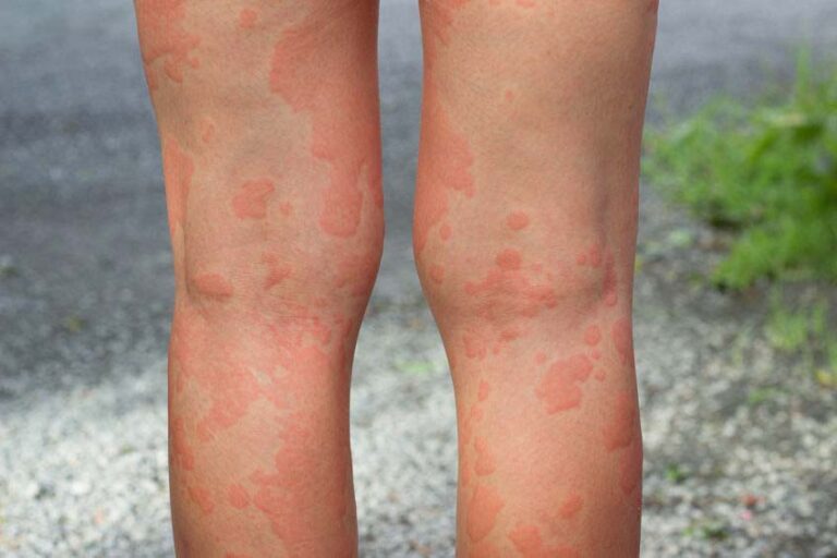 Alergia na pele com coceira? Entenda as causas e como tratar