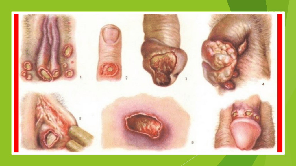 O que causa o cancro mole? Um guia para o diagnóstico